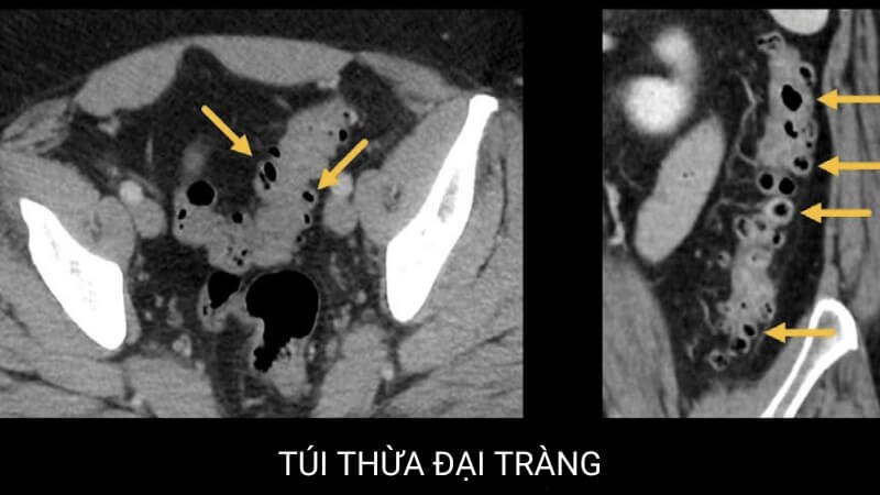 Hình ảnh túi thừa đại tràng trên CT-scan Hình ảnh túi thừa đại tràng trên CT-scan