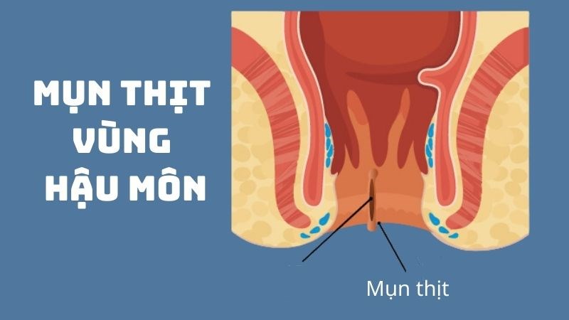 Nổi mụn ở trong hậu môn: Nguyên nhân và cách điều trị hiệu quả