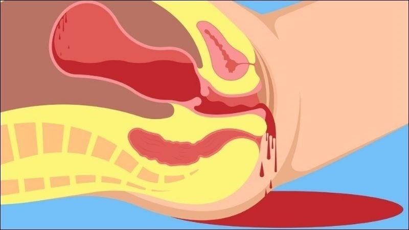 Ở người mẹ thai to sau sinh có nguy cơ cao đờ tử cung gây băng huyết