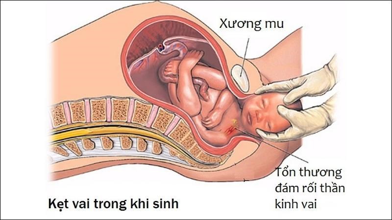 Người mẹ mang thai to khi sinh có thể gây chấn thương cho bé do đẻ khó