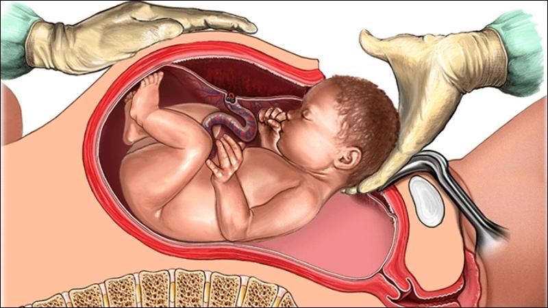 Trẻ đủ tháng được chẩn đoán thai to có chỉ định mổ lấy thai để an toàn cho mẹ và bé