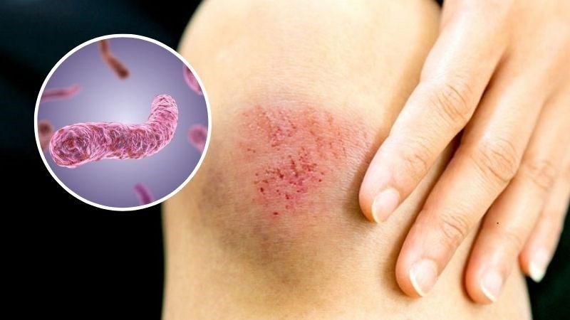 Bệnh lây truyền chủ yếu qua các vết thương hở