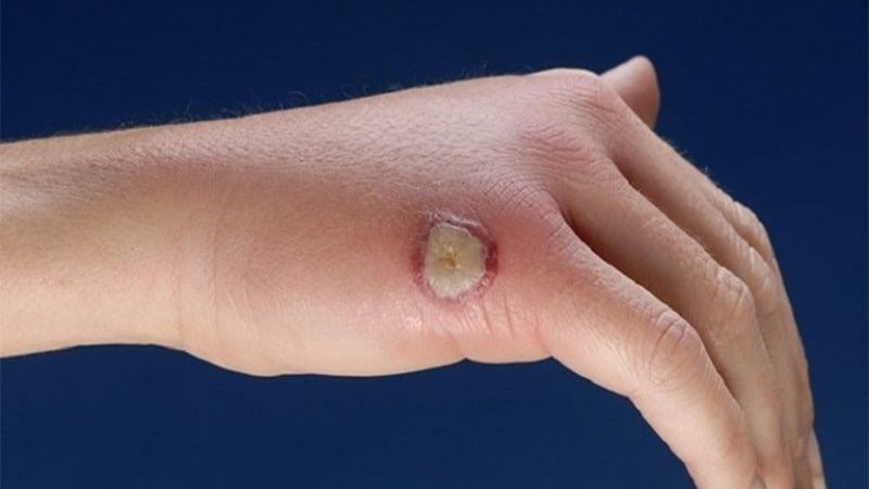 Vi khuẩn gây nhiễm trùng da tạo thành các vết loét