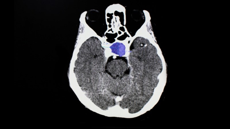 Hình ảnh MRI và CT giúp khảo sát kích thước khối ung thư tuyến yên