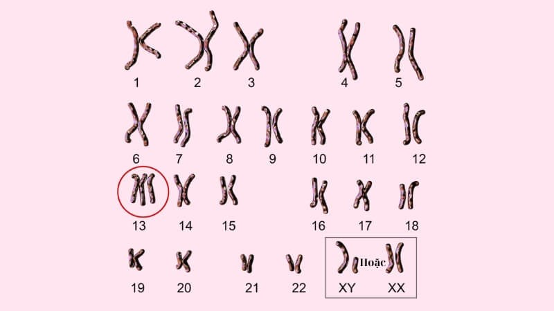 Hội chứng Patau xảy ra khi người bệnh mang 3 bản sao NST số 13 Hội chứng Patau xảy ra khi người bệnh mang 3 bản sao NST số 13