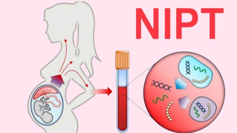 NIPT là xét nghiệm có giá trị cao trong sàng lọc hội chứng Patau trước khi sinh NIPT là xét nghiệm có giá trị cao trong sàng lọc hội chứng Patau trước khi sinh