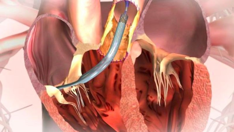 Can thiệp phẫu thuật cũng có thể là nguyên nhân gây hở van động mạch phổi Can thiệp phẫu thuật cũng có thể là nguyên nhân gây hở van động mạch phổi