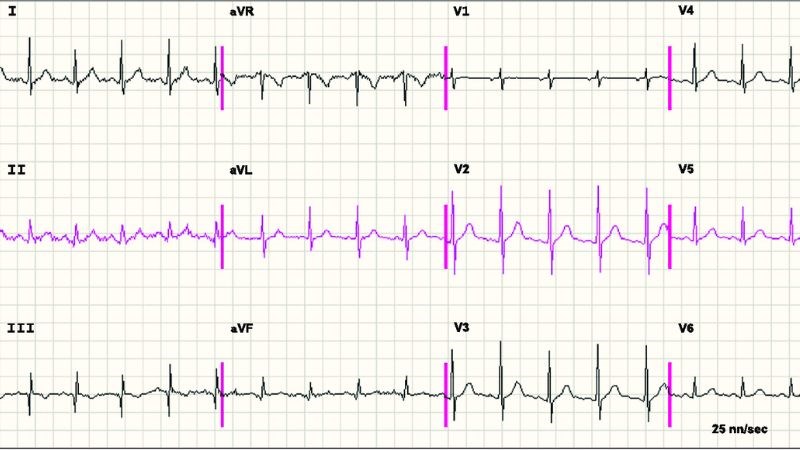 Điện tâm đồ là một xét nghiệm quan trọng trong việc theo dõi và chẩn đoán bệnh Điện tâm đồ là một xét nghiệm quan trọng trong việc theo dõi và chẩn đoán bệnh