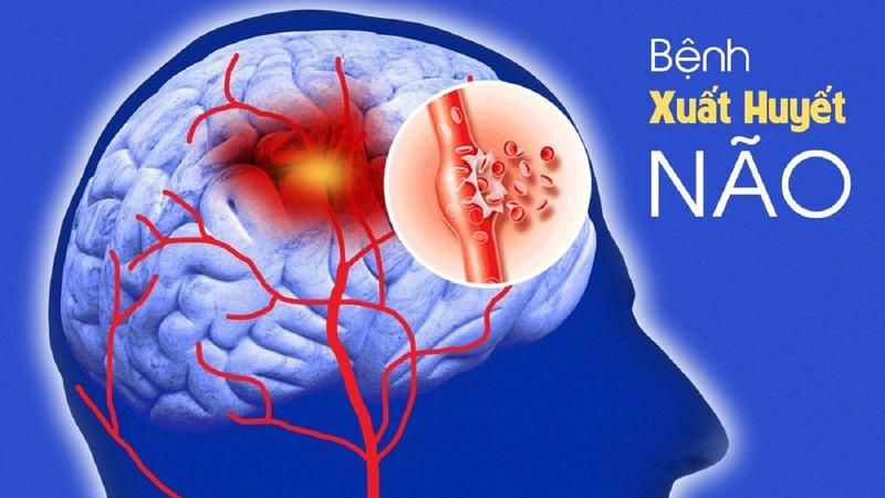 Xuất huyết não là tình trạng có máu trong nhu mô não
