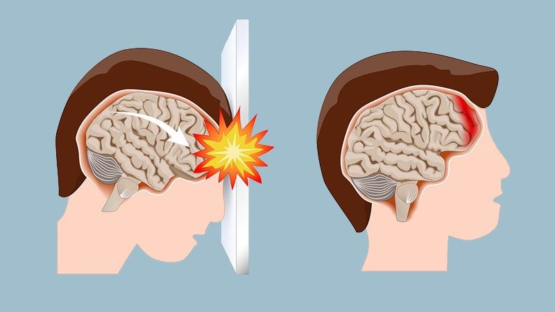 Chấn thương sọ não là nguyên nhân chủ yếu gây xuất huyết não