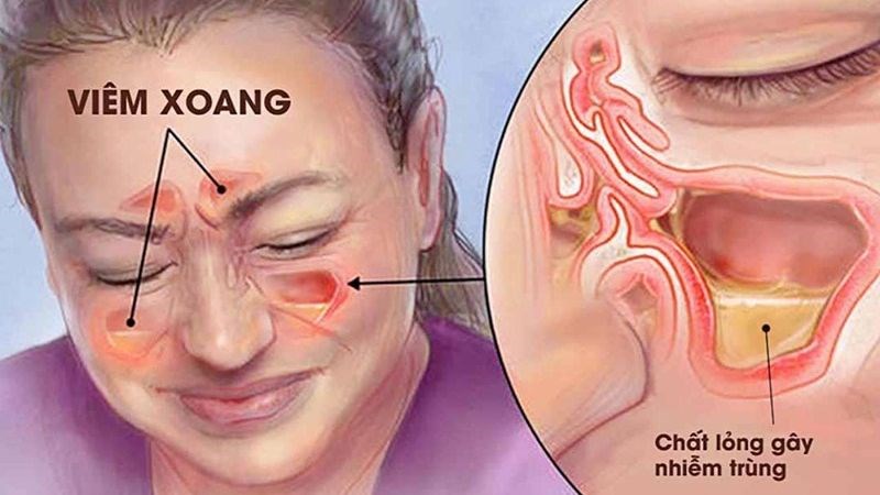 Người bệnh có thể bị viêm xoang nếu dị ứng lông chó mèo