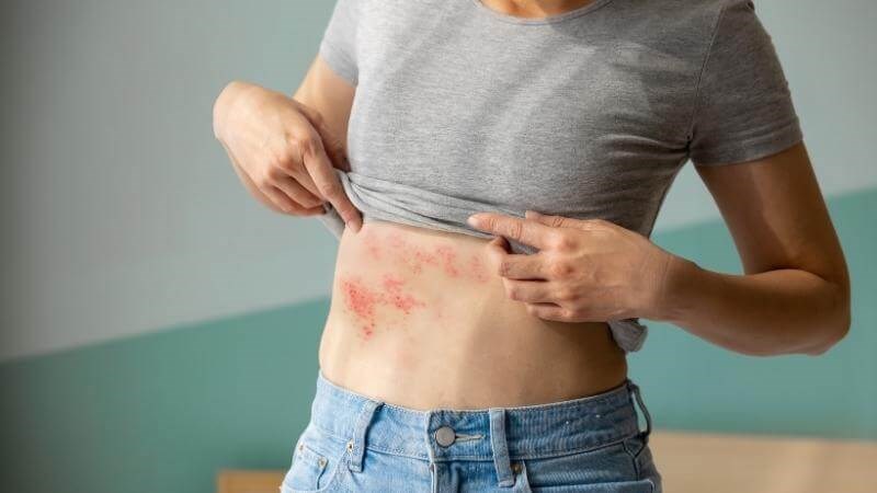Zona thần kinh nếu không điều trị tại chỗ hiệu quả có thể lây lan và gây tê mặt