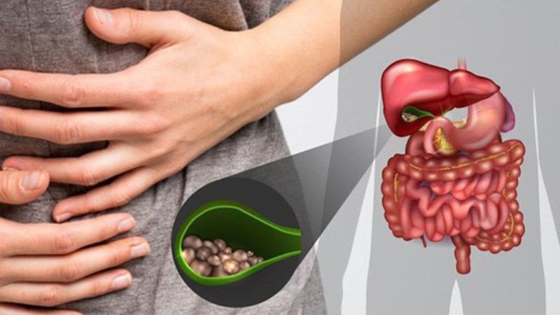 Sự cản trở trong việc tiết mật từ gan đến ruột thường do ốn mật chủ bị tắc nghẽn, dẫn đến tình trạng vàng da sau gan.