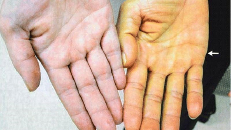 Dấu hiệu và triệu chứng của vàng da bao gồm màu da và mắt biến đổi thành màu vàng