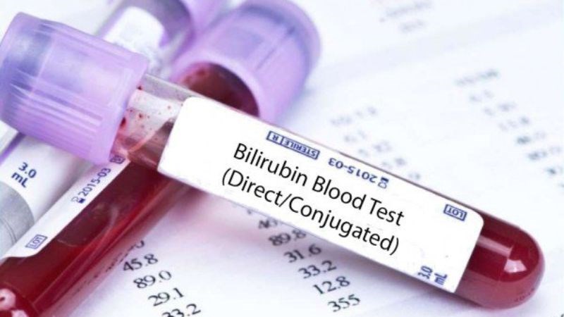 Xét nghiệm máu đo lượng bilirubin có thể giúp chẩn đoán vàng da