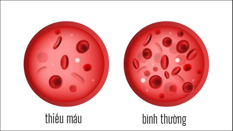 Thiếu máu là một trong những nguyên nhân gây suy nhược