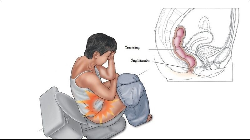 Đau hậu môn là tình trạng đau ở trong và xung quanh hậu môn hoặc trực tràng