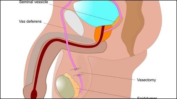Sau thắt ống dẫn tinh có thể gây đau tinh hoàn Sau thắt ống dẫn tinh có thể gây đau tinh hoàn