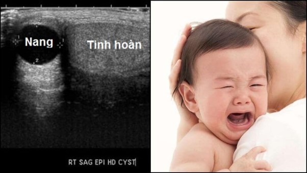 Nang nước thừng tinh hay gặp ở trẻ em Nang nước thừng tinh hay gặp ở trẻ em