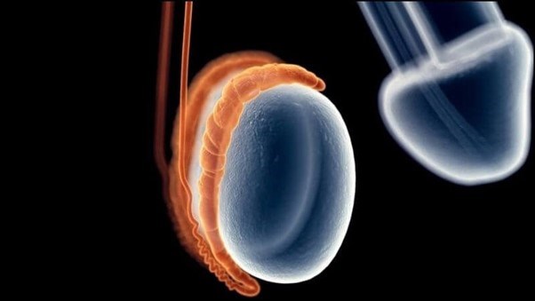 Viêm mào tinh hoàn Viêm mào tinh hoàn