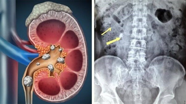 Sỏi thận gây đau tinh hoàn Sỏi thận gây đau tinh hoàn
