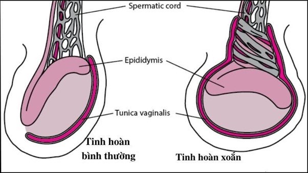 Xoắn tinh hoàn là tình trạng cần cấp cứu Xoắn tinh hoàn là tình trạng cần cấp cứu
