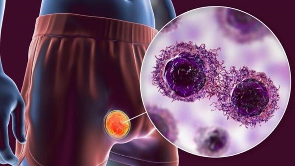 Ung thư tinh hoàn gây đau tinh hoàn Ung thư tinh hoàn gây đau tinh hoàn