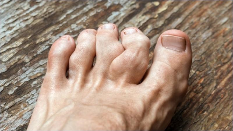 Các khớp sưng mà không điều trị có thể bị biến dạng