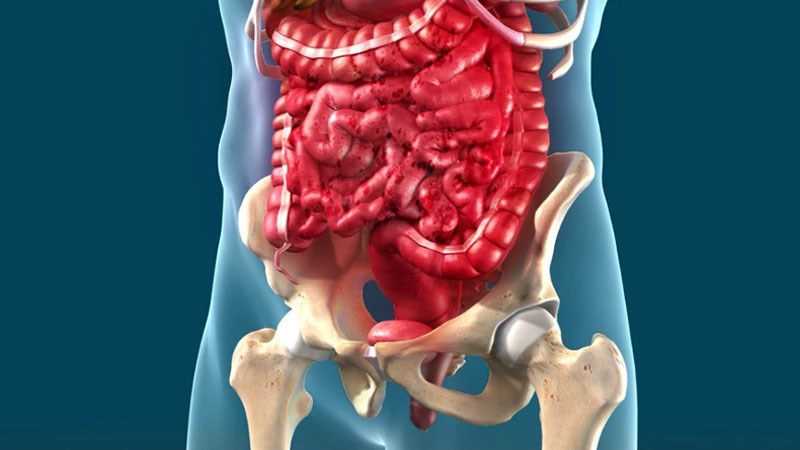 Viêm ruột (IBD) là một trong những nguyên nhân gây đau bụng dữ dội