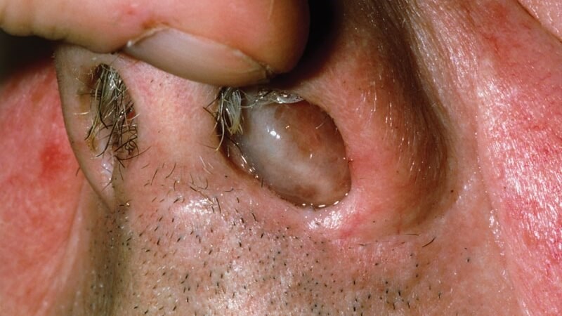 Các khối u trong mũi làm xuất hiện các triệu chứng nghẹt mũi, ngứa mũi