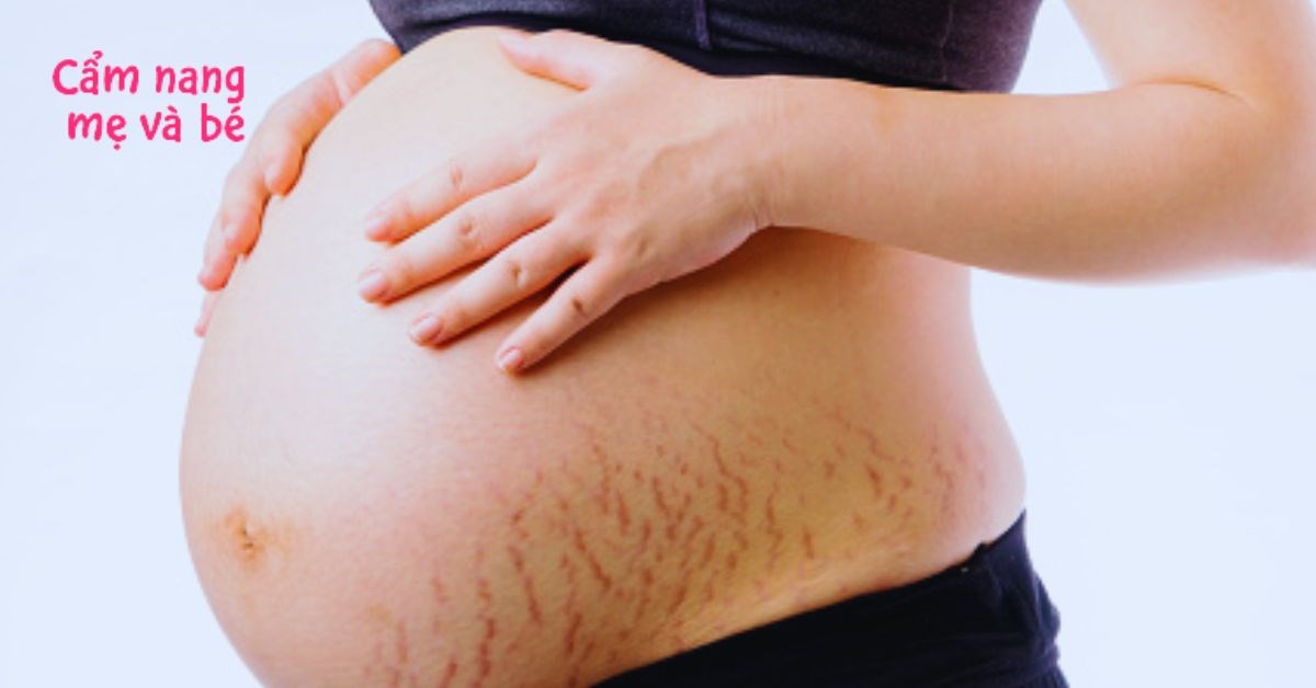 6 cách chữa rạn da sau sinh bằng nghệ tại nhà cực hiệu quả