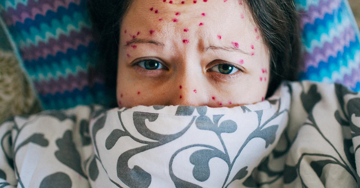 Giải đáp thắc mắc: Bà bầu bị thủy đậu nên kiêng gì để bảo vệ con?