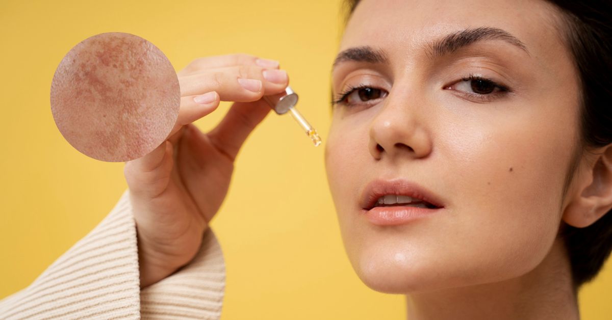 Mách mẹ cách chăm sóc da mặt bị nám giúp cho làn da trắng sáng