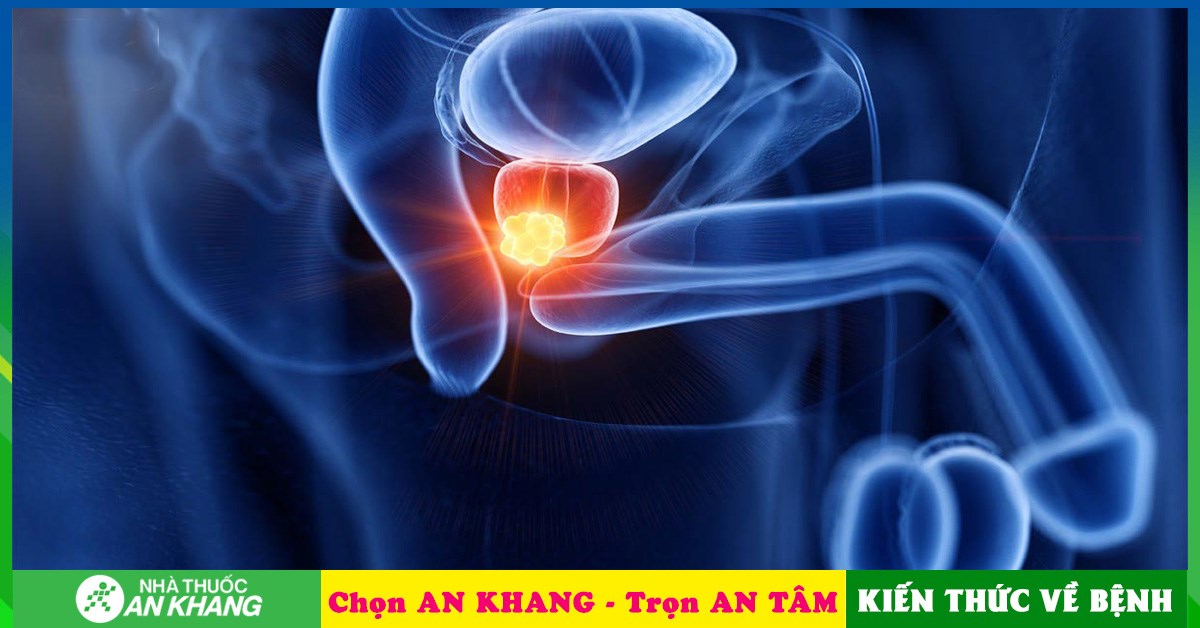 Có những yếu tố nào có thể gia tăng nguy cơ mắc ung thư tiền liệt tuyến di căn xương?