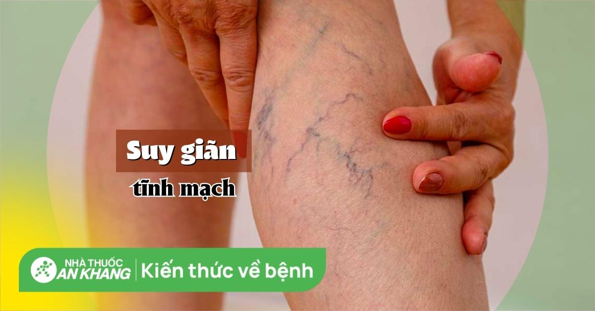 Suy giãn tĩnh mạch: Nguyên nhân, dấu hiệu, cách điều trị và cách phòng ngừa