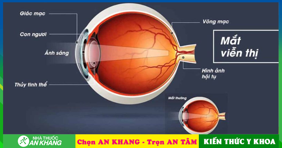 Mắt không đảm bảo tầm nhìn có liên quan đến nguyên nhân viễn thị không?
