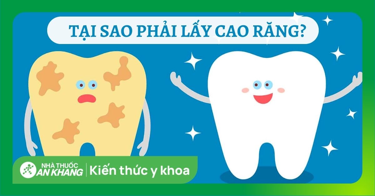 Làm sao để biết mình cần lấy cao răng?
