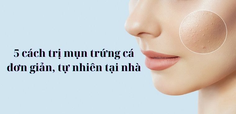 5 cách trị mụn trứng cá đơn giản tự nhiên tại nhà hiệu quả
