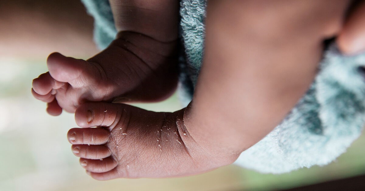 Trẻ sơ sinh bị khô da - Những lưu ý khi chăm sóc da trẻ từ bác sĩ Trương Hữu Khanh