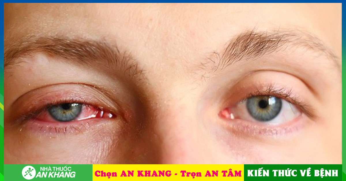 Nguyên nhân gây bệnh đau mắt đỏ có liên quan đến yếu tố nào?
