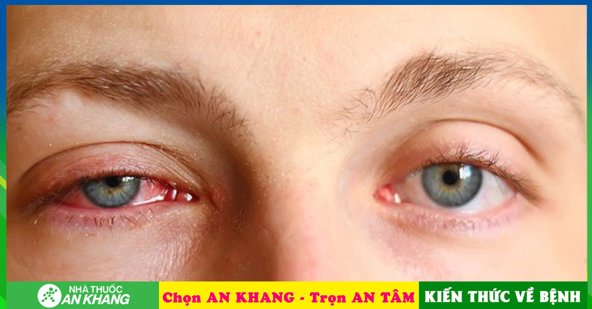 Bệnh đau mắt đỏ có ảnh hưởng gì đến thị lực không?