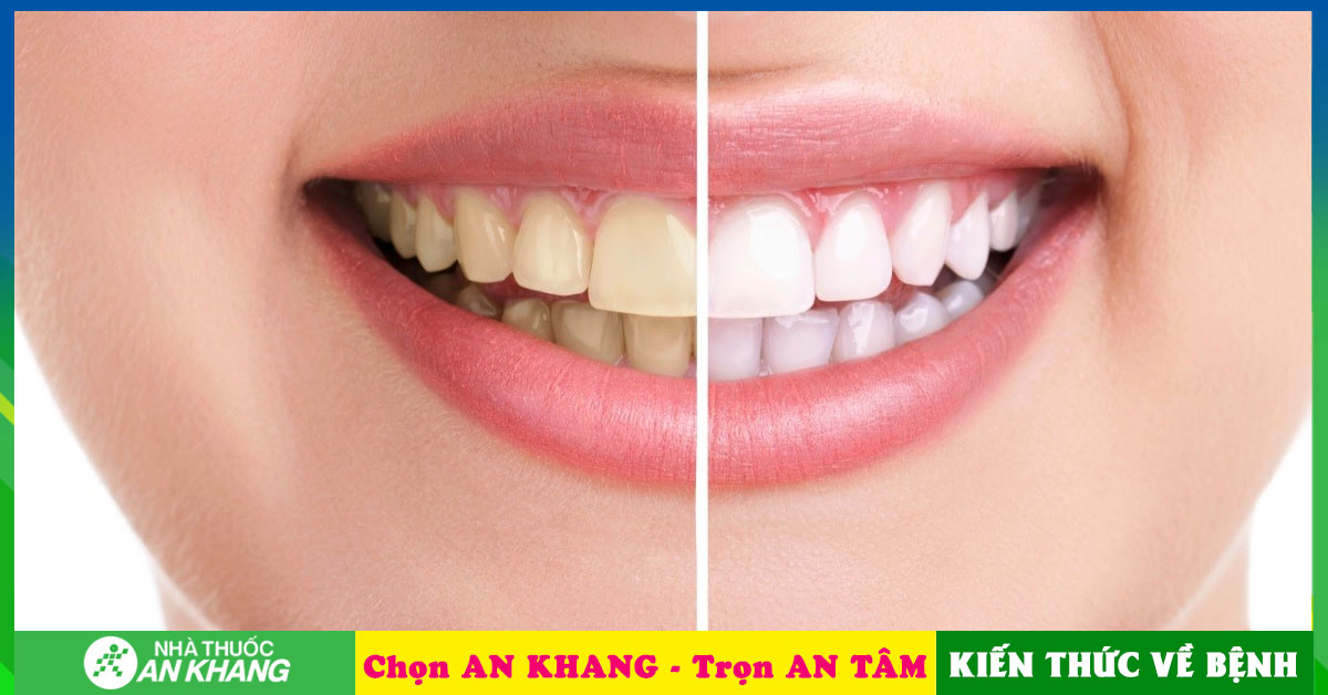Răng vàng thường do nguyên nhân gì gây ra?

