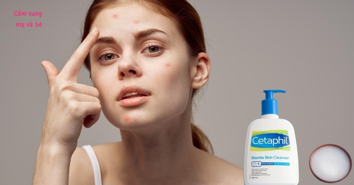 Nguyên nhân dùng sữa rửa mặt Cetaphil bị nổi mụn và cách khắc phục