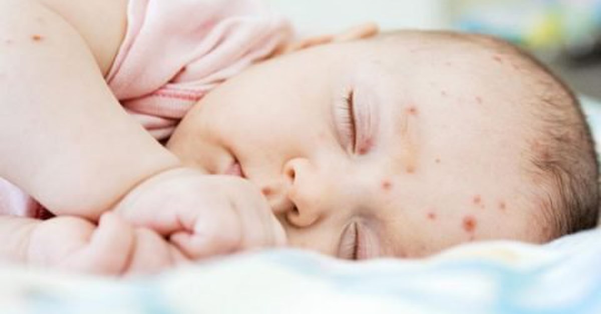 Bệnh sởi là gì? Giải đáp những câu hỏi liên quan đến bệnh sởi