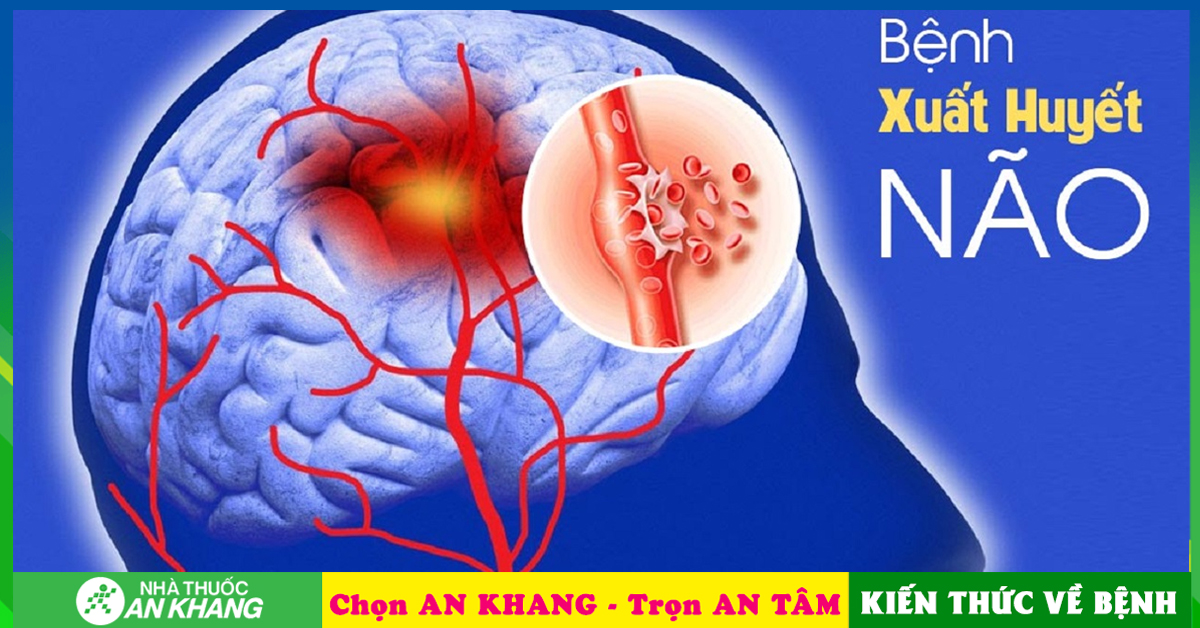 Phương pháp điều trị đột quỵ xuất huyết não bạn nên biết