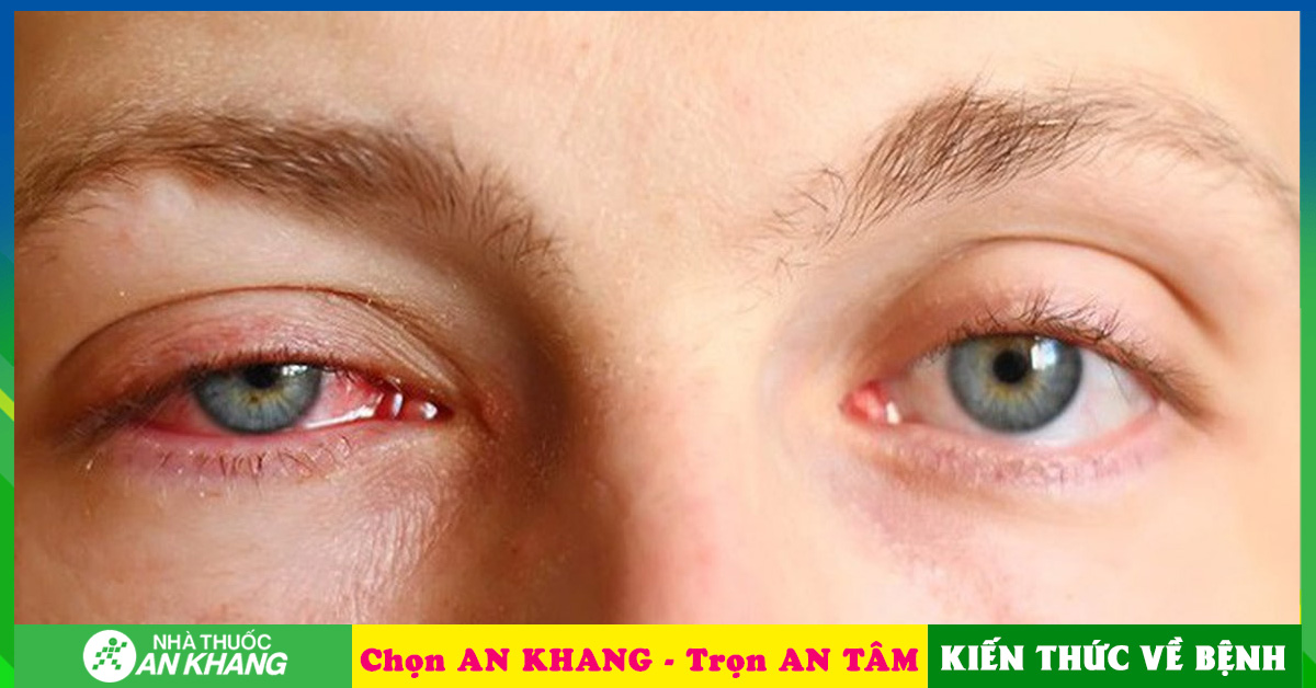 Tại sao người bị đau mắt hột có cảm giác ngứa và kích ứng mắt?
