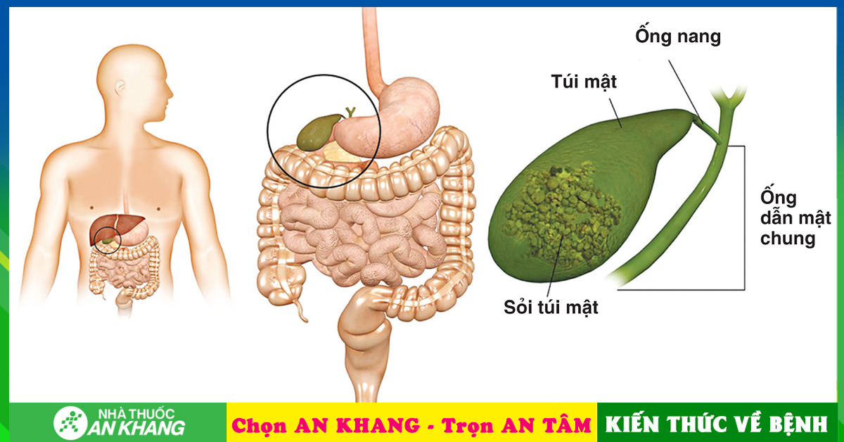 Sỏi túi mật có thể gây ra những vấn đề sức khỏe nào khác?
