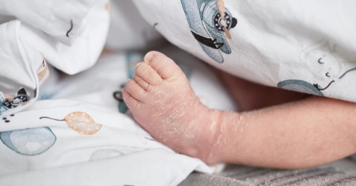 Chăm sóc trẻ sơ sinh bị khô da theo lời khuyên từ Bác sĩ Trương Hữu Khanh