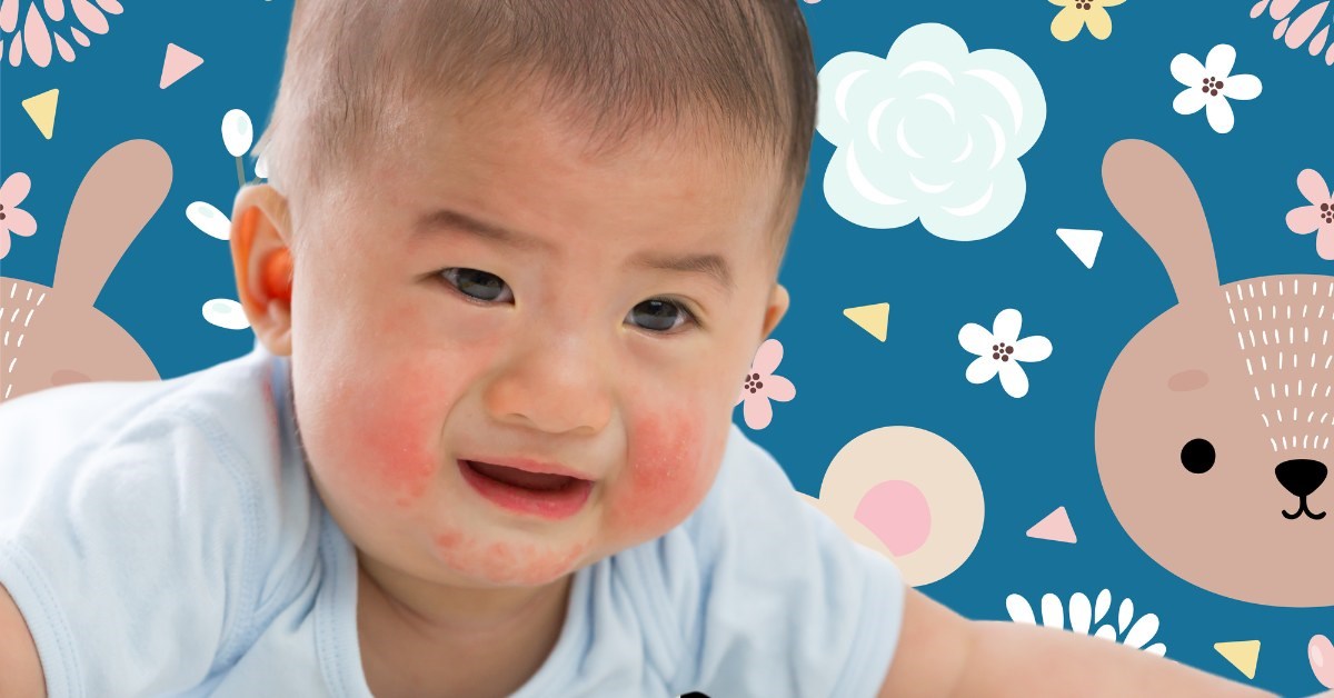 Dấu hiệu chàm sữa ở trẻ sơ sinh ba mẹ không nên bỏ qua