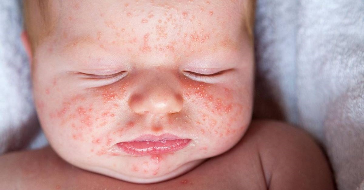 Điều trị viêm da cơ địa ở trẻ em tại nhà đúng cách